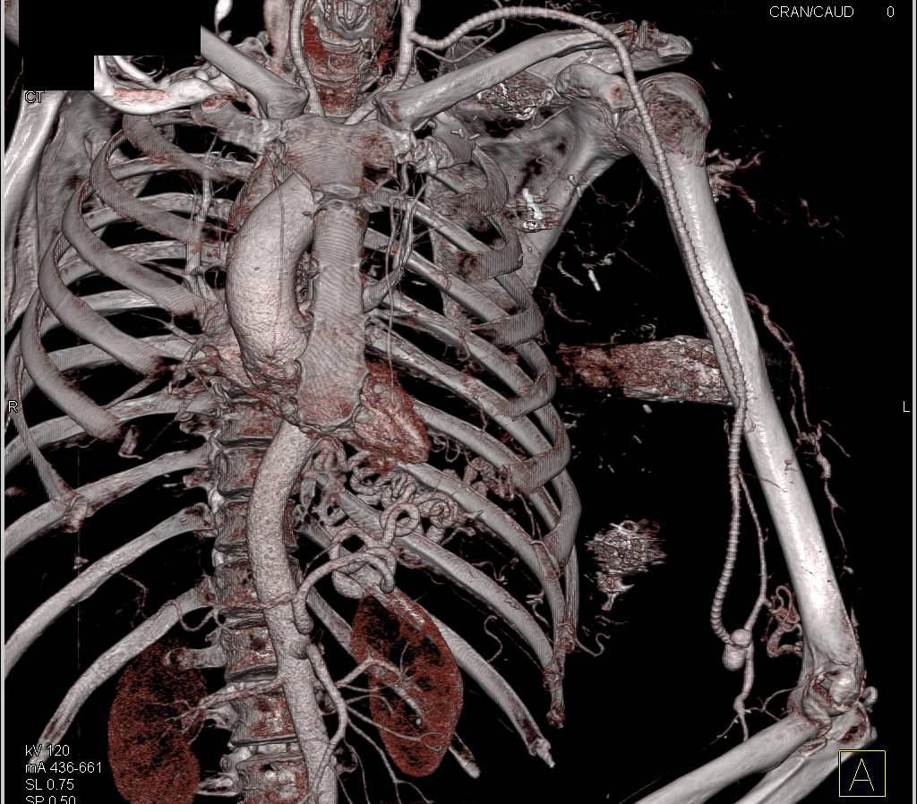 Occlusion Left Brachial Artery with Bypass from Left Subclavian to Distal Brachial Artery - CTisus CT Scan