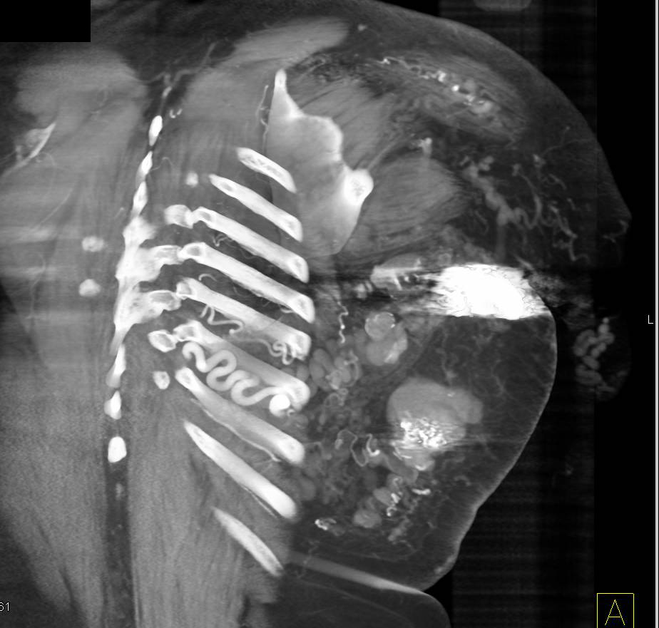 Vascular Graft with Extensive Chest Wall Collaterals - CTisus CT Scan
