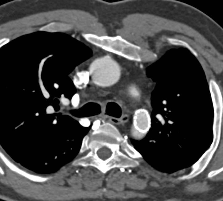 Coarctation of the Aorta Repaired with Stent - CTisus CT Scan