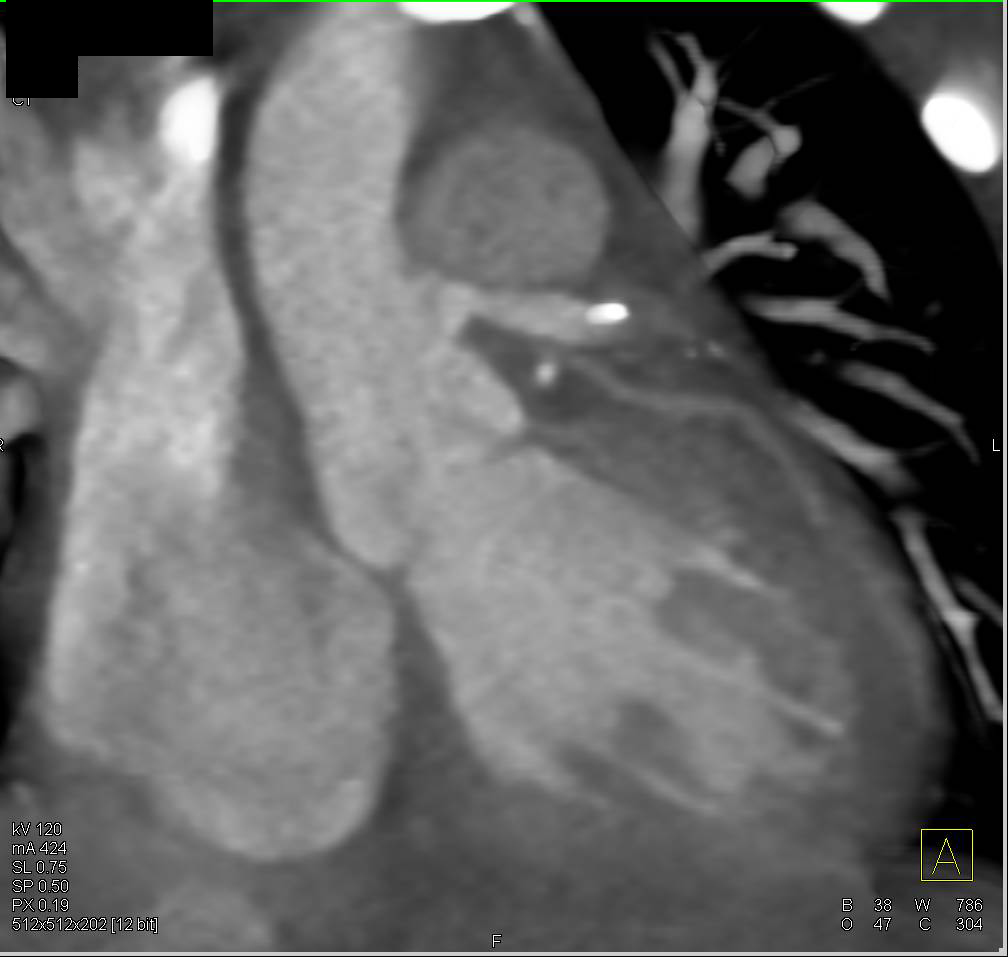 Reimplanted Aorta  with  Coronary Artery Analysis - CTisus CT Scan
