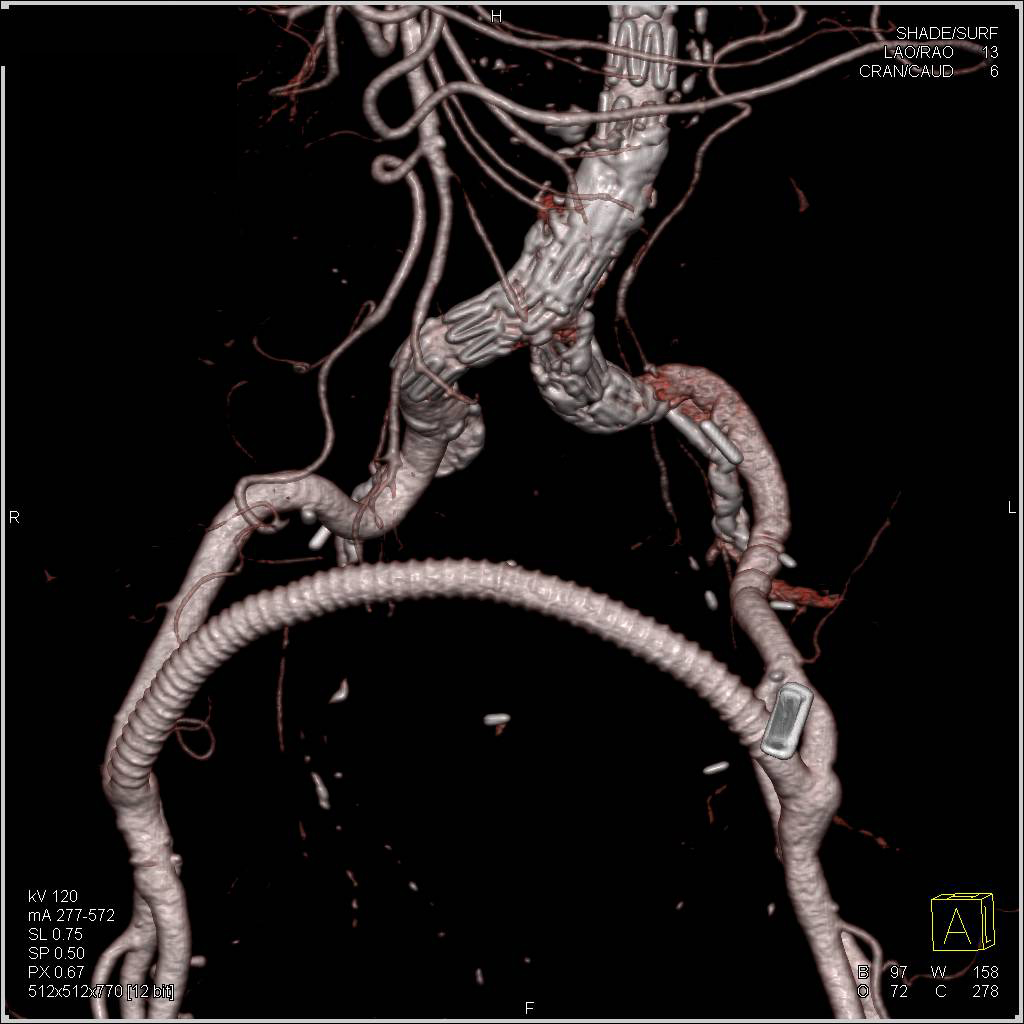 Endovascular Stent Abdominal Aorta with Endoleak as well as Fem-Fem Bypass - CTisus CT Scan