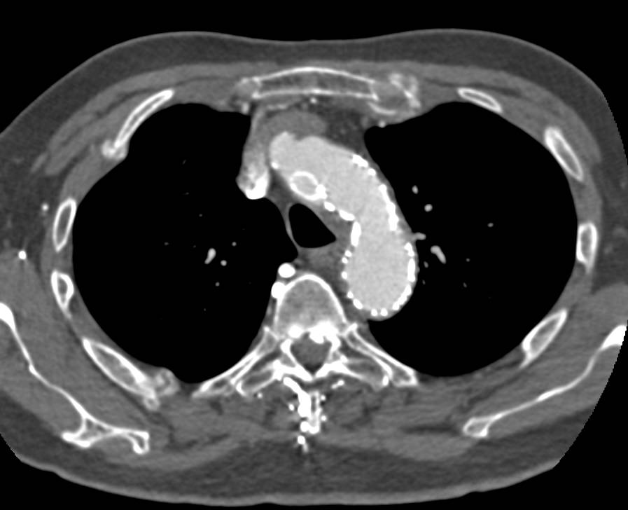 Endovascular Stent in Arch and into Left Subclavian Artery - CTisus CT Scan