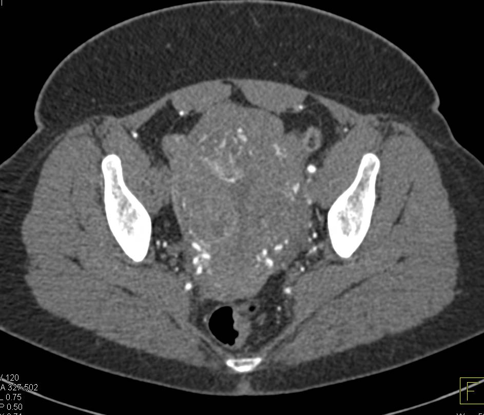 Occluded Right Common Iliac Artery and Uterine Fibroids - CTisus CT Scan