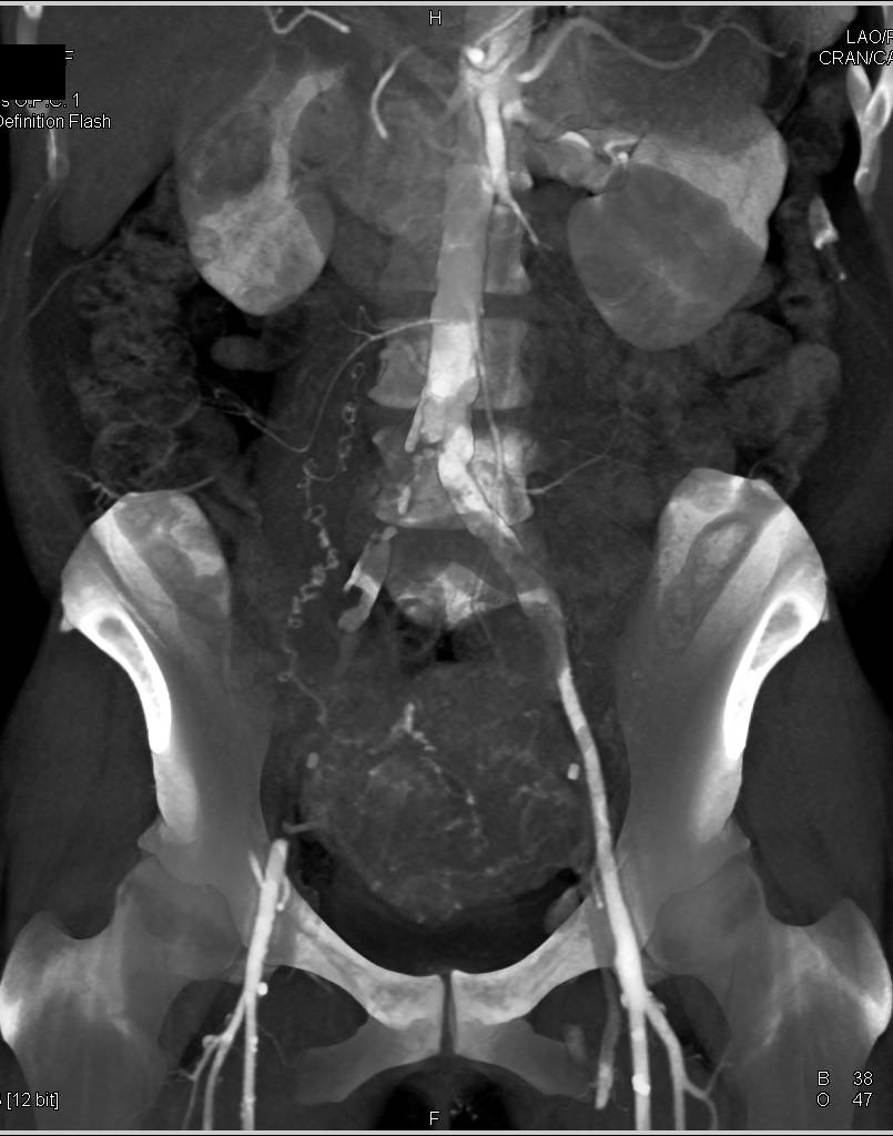 Occlusion Right Common Iliac and External Iliac Artery - CTisus CT Scan