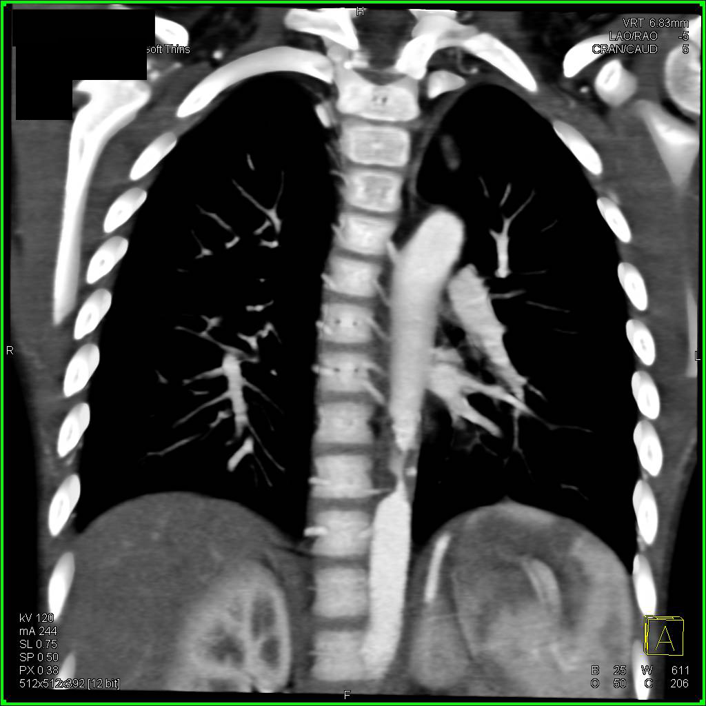 Dilated Internal Mammary Arteries in Patient with Mid-Aortic Stenosis - CTisus CT Scan
