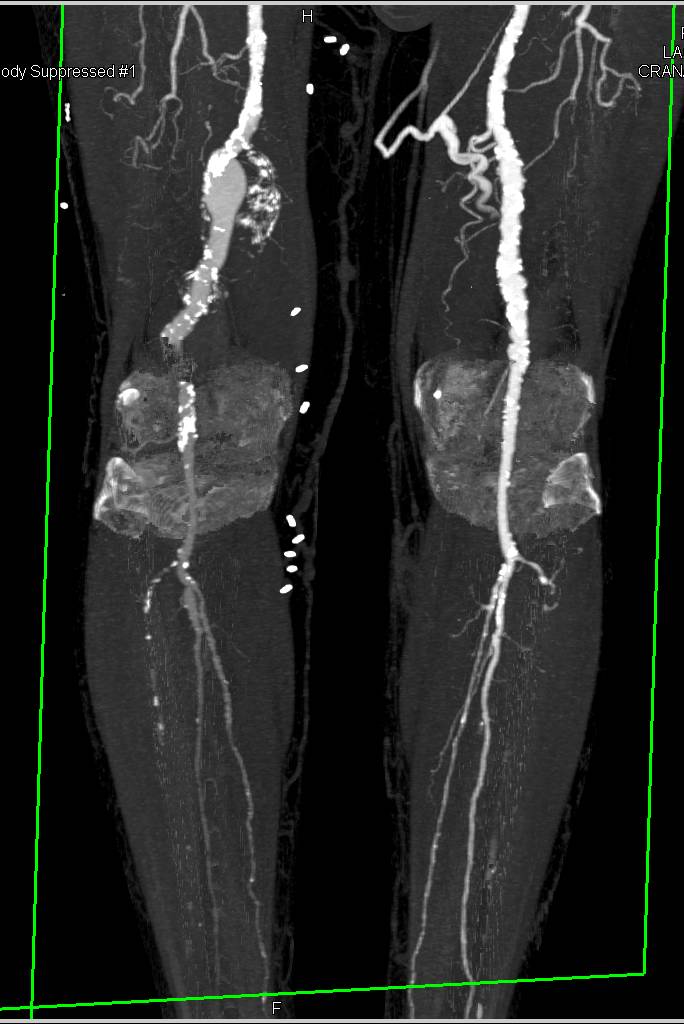 Extensive Vascular Disease with Multiple Aneurysms well seen in 3D - CTisus CT Scan
