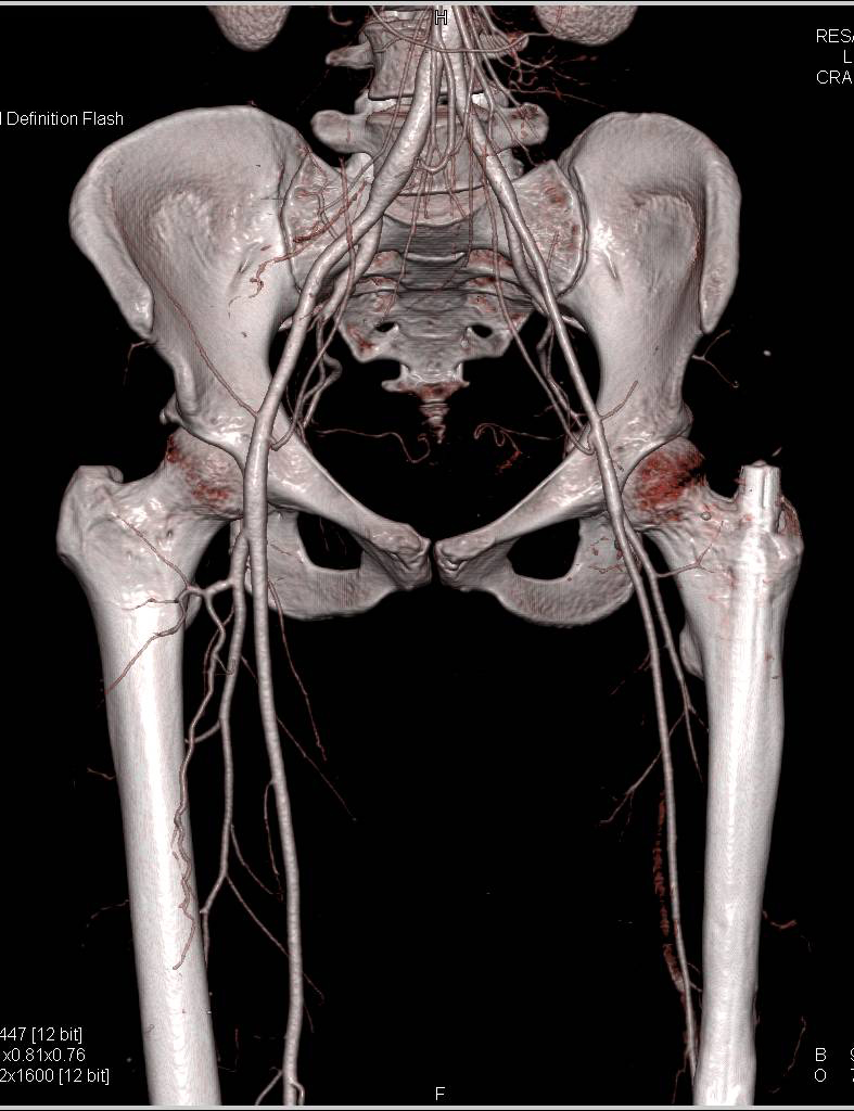 CTA Runoff in Patient with Reimplanted Lower Extremity - CTisus CT Scan
