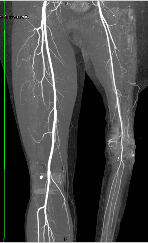 CTA Runoff in Patient with Reimplanted Lower Extremity - CTisus CT Scan