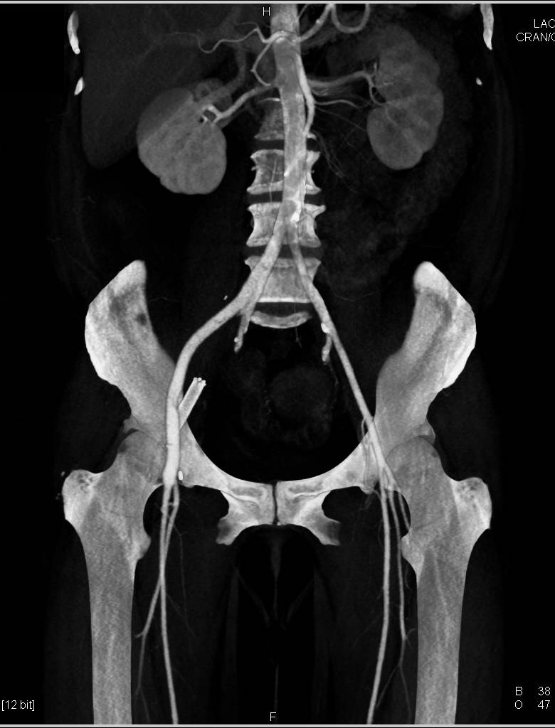 Misplaced Stent Near Right External Iliac Artery - CTisus CT Scan