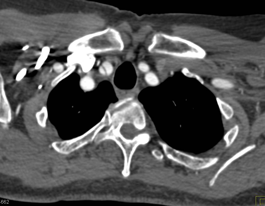 Type A Dissection Involves Vessels Ranging from Right Carotid Artery to Left Renal Artery - CTisus CT Scan