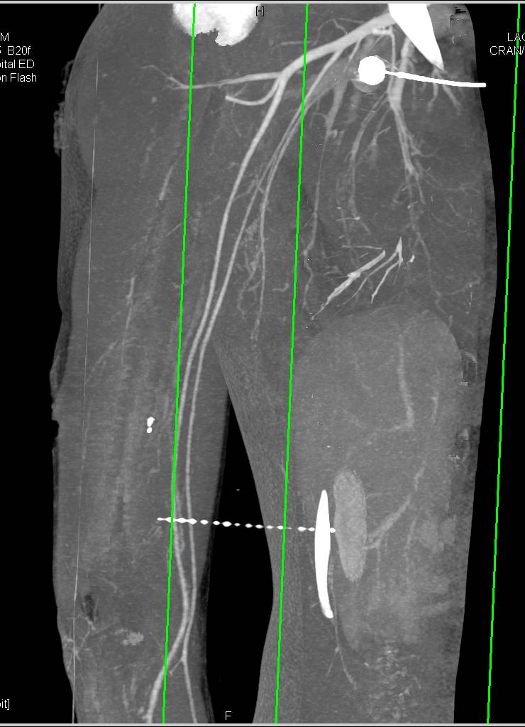 CTA Upper Extremity Without Vascular Injury with Bone Removal - CTisus CT Scan