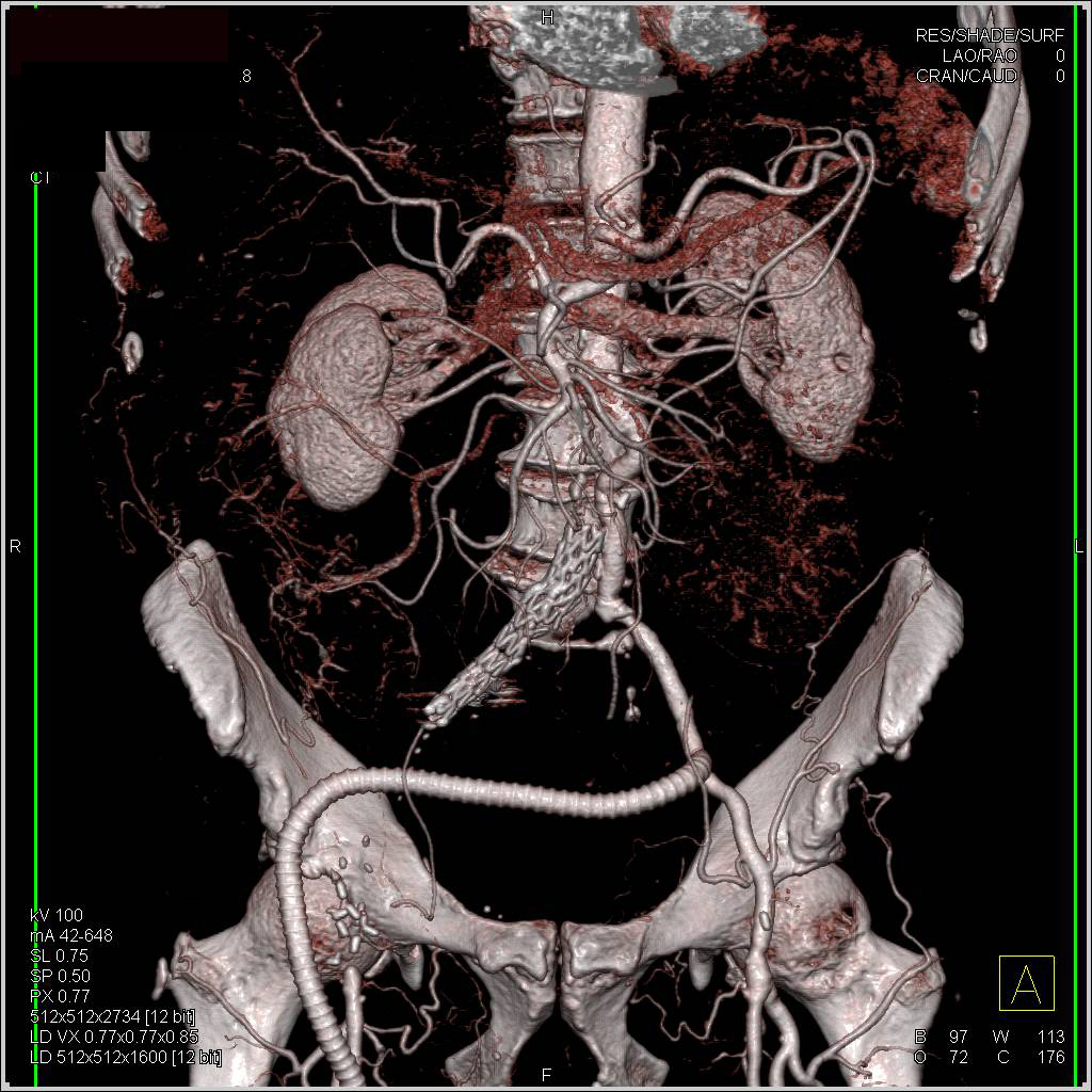 Dual Energy Runoff Study - CTisus CT Scan