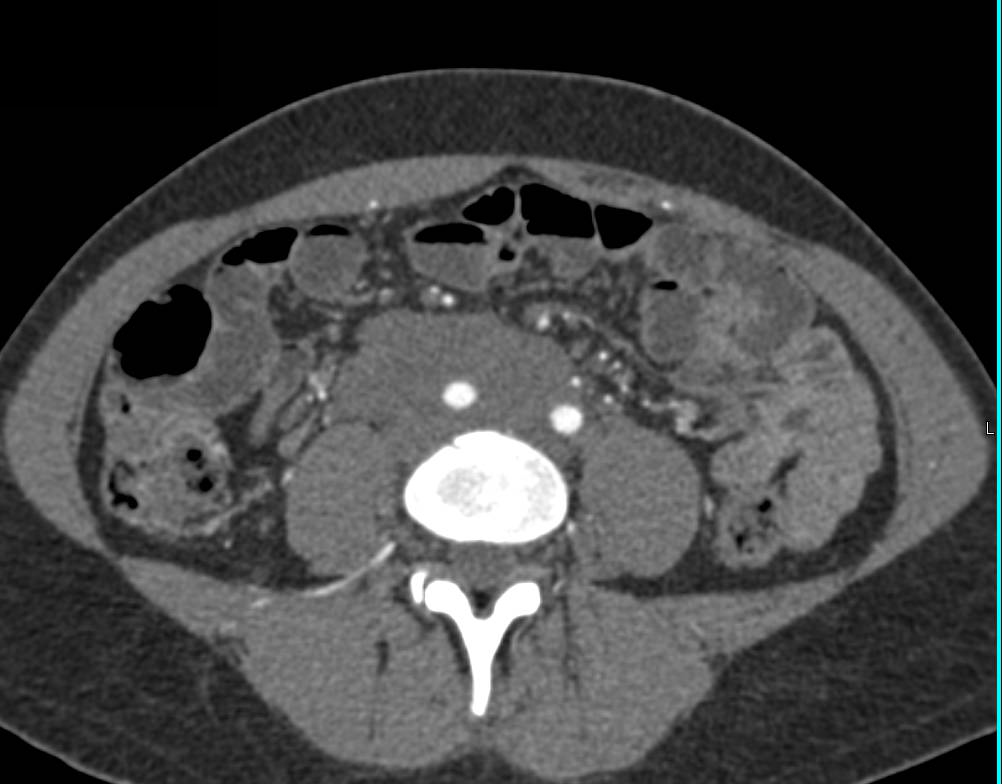 Unusual Appearance of Retroperitoneal Fibrosis Which Simulates a Neoplasm - CTisus CT Scan