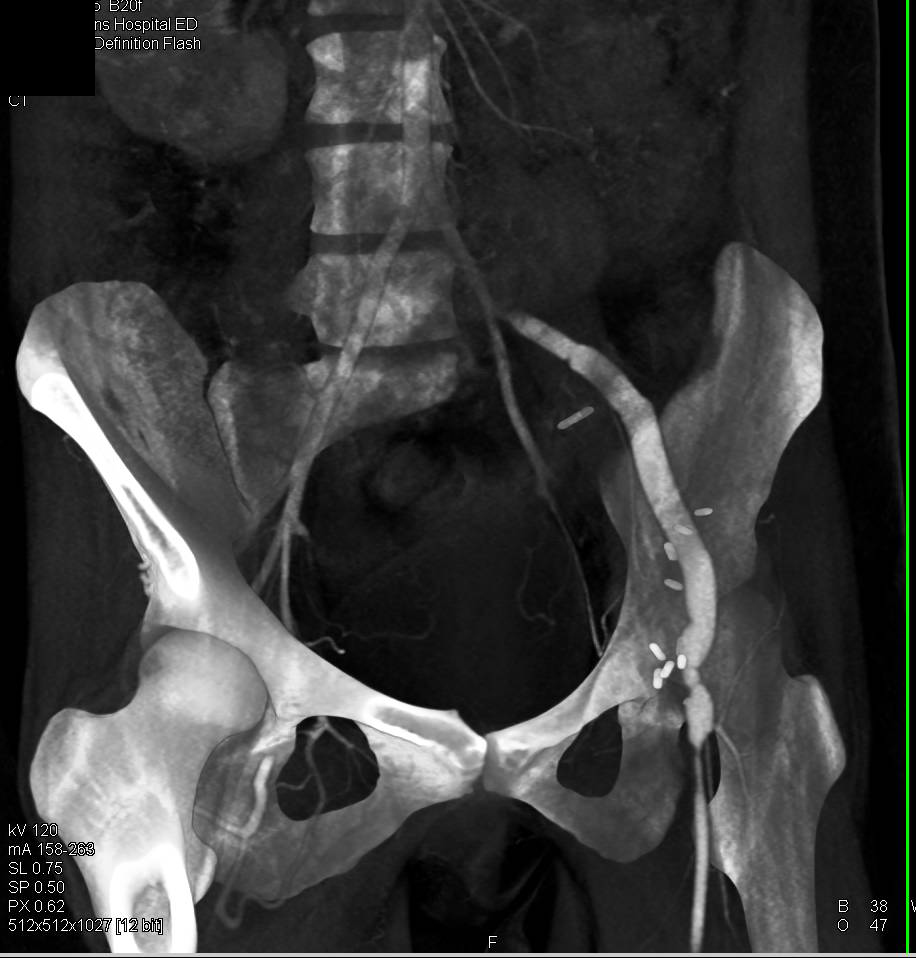 Unusual Vascular Graft from Left Iliac Artery with Stenosis and 3D Vascular Mapping - CTisus CT Scan