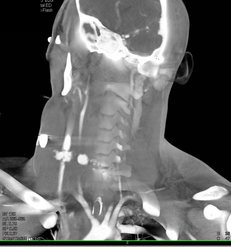 GSW with Injury to Right Carotid Artery with Active Bleeding Seen - CTisus CT Scan