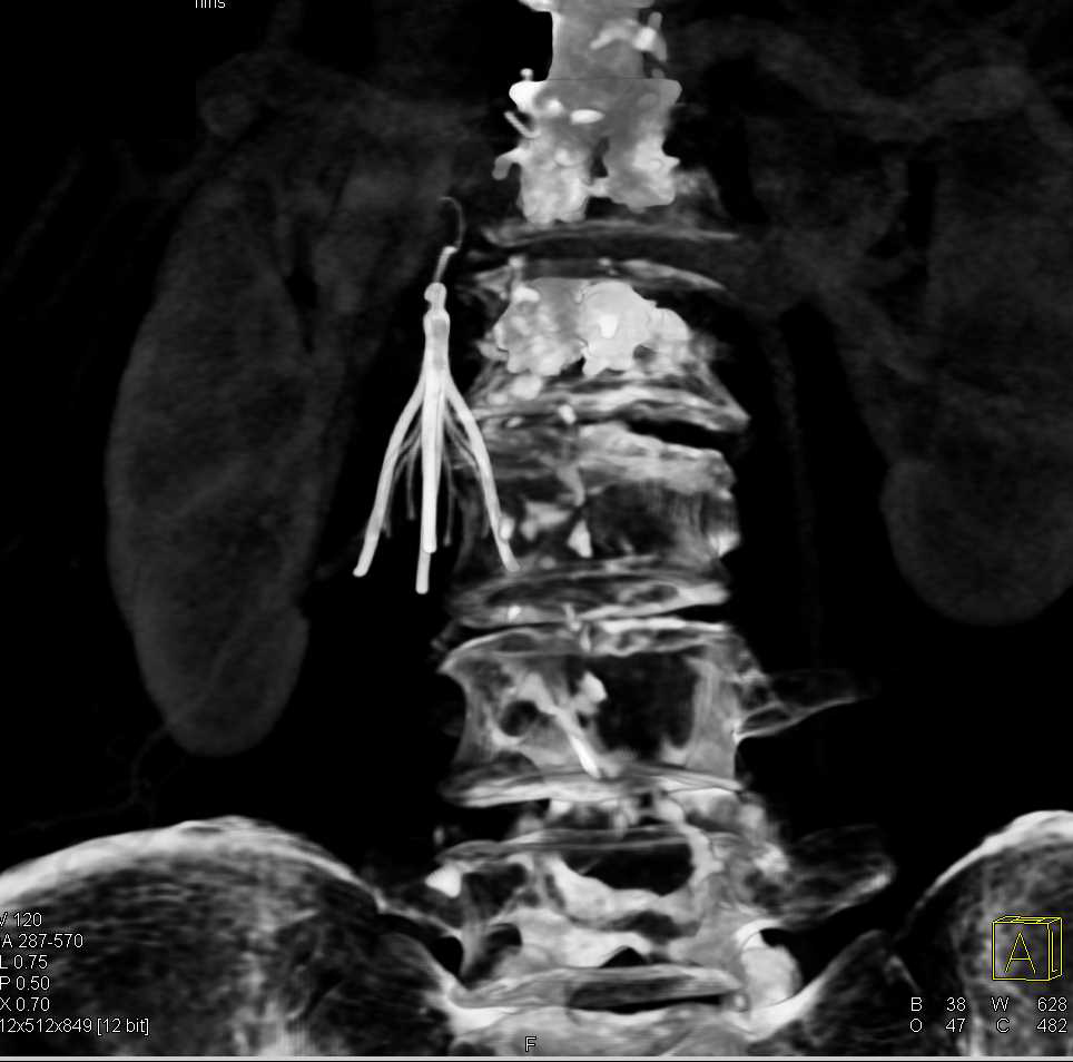 3D of Inferior Vena Cava (IVC) Filter - CTisus CT Scan