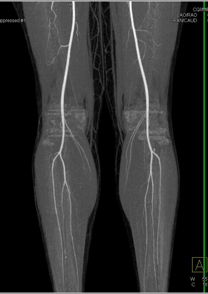 Normal CTA Runoff with DE CT - CTisus CT Scan