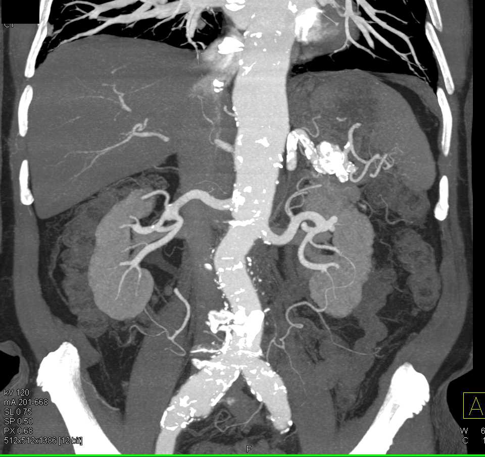 Focal Dissection in Right Common Iliac Artery - CTisus CT Scan