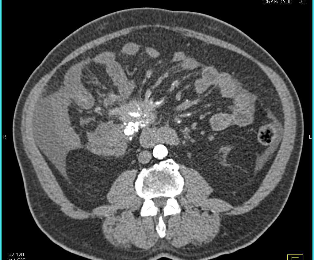 Carcinoid Tumor in the Root of the Mesentery Involves the Superior Mesenteric Artery (SMA) and Superior Mesenteric Vein (SMV) - CTisus CT Scan