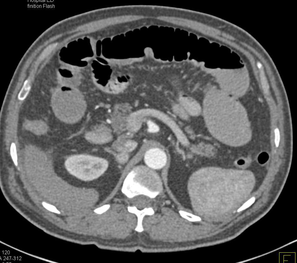 Median Arcuate Ligament Syndrome - CTisus CT Scan