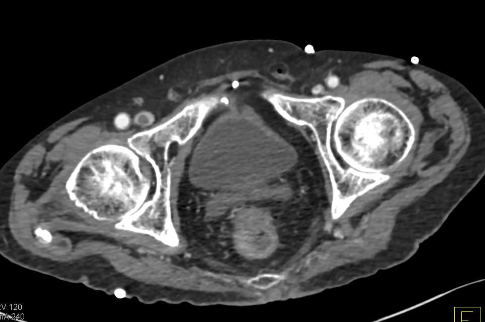 Right Femoral Vein Deep Vein Thrombosis (DVT) - CTisus CT Scan