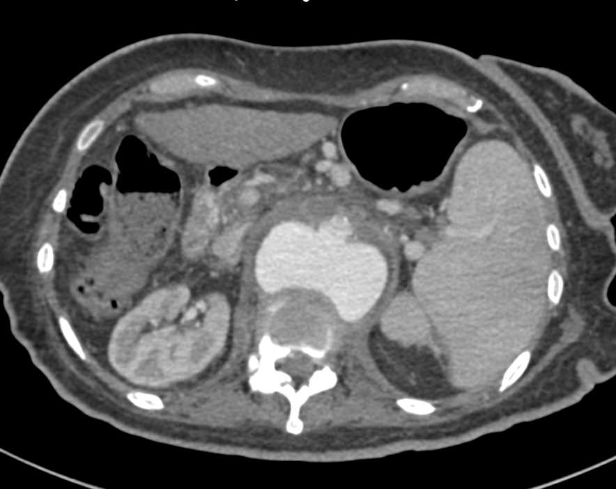 Mycotic Aortic Aneurysm with Early Spine Erosion - CTisus CT Scan