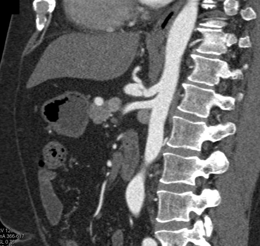 Focal Celiac Artery Aneurysm with Dissection - CTisus CT Scan