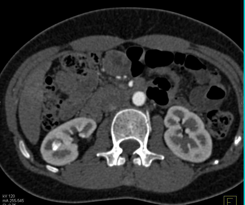 Popliteal Artery Aneurysm - CTisus CT Scan