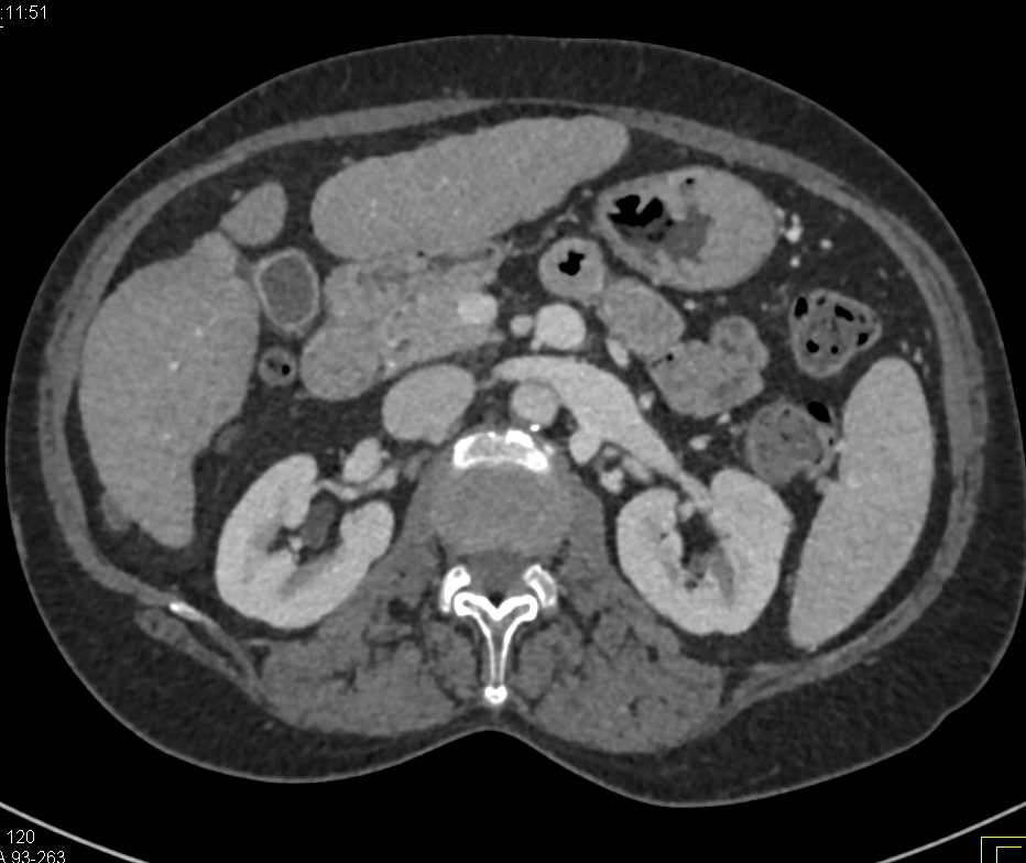 Splenorenal Shunting due to Portal Hypertension - CTisus CT Scan