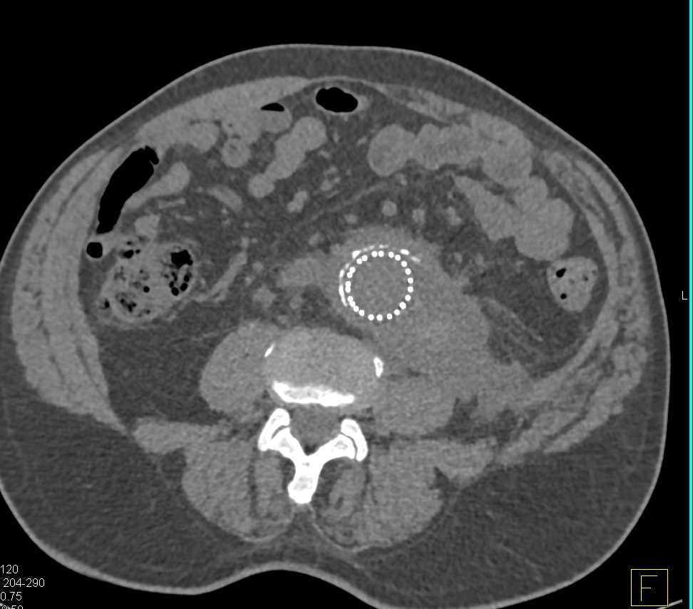 Psoas Bleed Following Abdominal Aortic Aneurysm (AAA) Repair - CTisus CT Scan