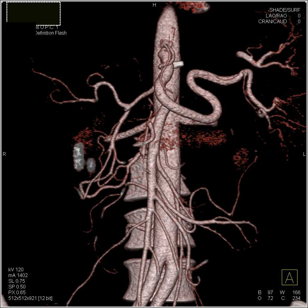 Celiac Artery Stenosis and Focal Dissections - CTisus CT Scan