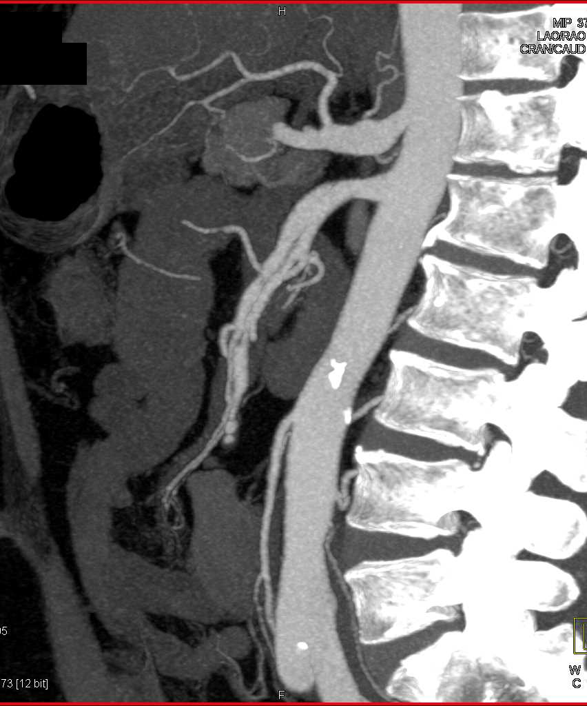 Superior Mesenteric Artery (SMA) Dissection with Vasculitis - CTisus CT Scan
