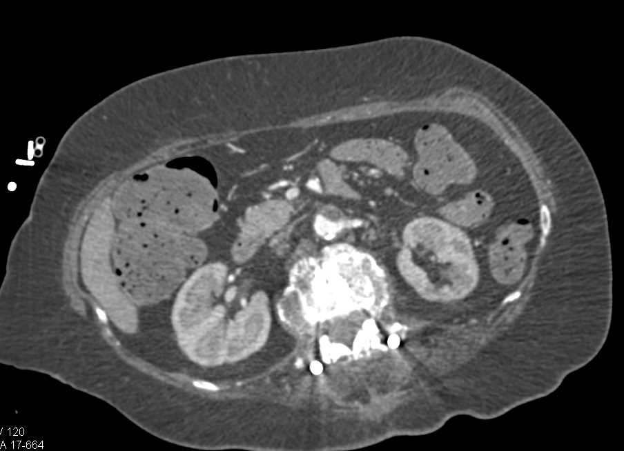 Near Occlusion of the Abdominal Aorta - CTisus CT Scan