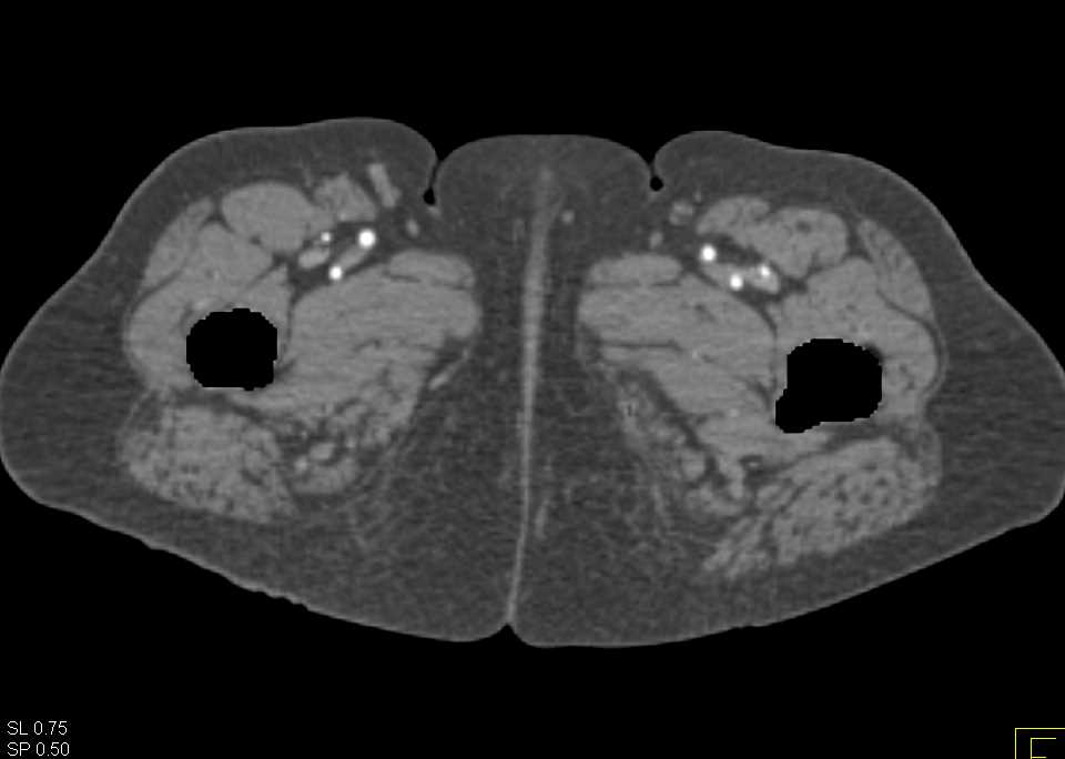 Dual Energy CT Angiogram with Peripheral Vascular Disease in Superficial Femoral Artery (SFA) - CTisus CT Scan