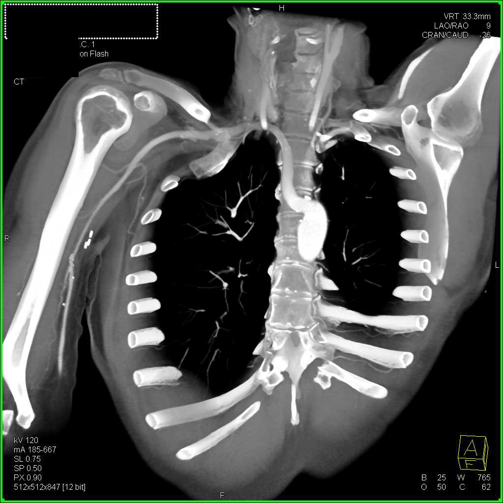 Right Subclavian Artery Aneurysm - CTisus CT Scan
