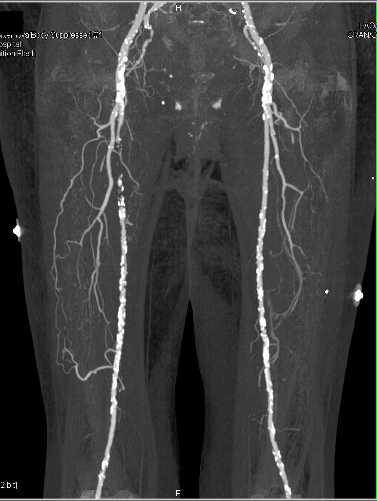 DE CTA Runoff with Occluded Right Superficial Femoral Artery (SFA) - CTisus CT Scan