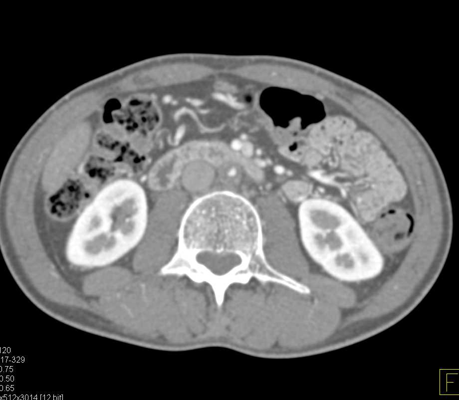 Mid-Abdominal Aortic Stenosis Seen on 3D - CTisus CT Scan