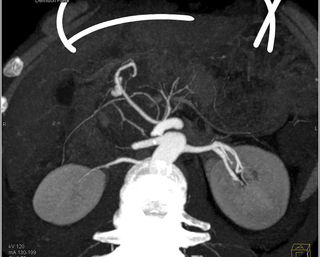 Gastroduodenal Artery (GDA) Bleed Seen on CT Angiogram in a Patient with Pancreatitis with Embolization - CTisus CT Scan