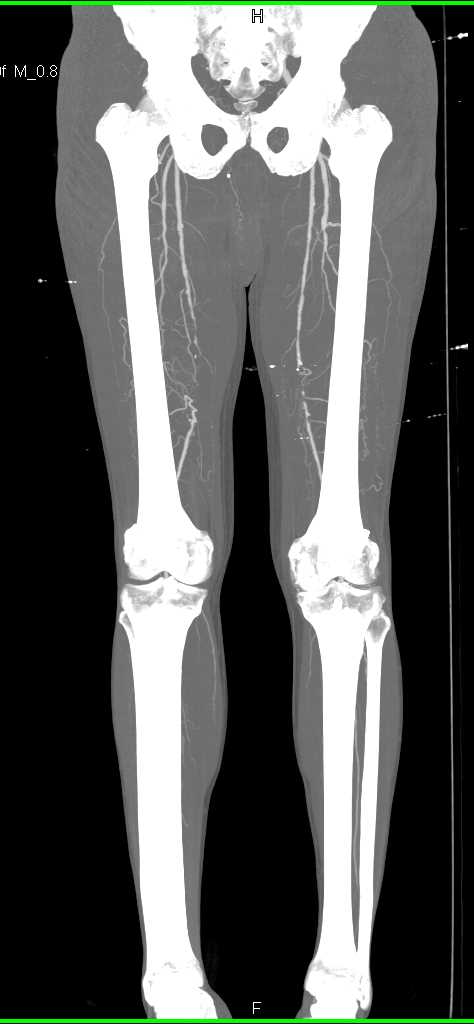 Bilateral Superficial Femoral Artery (SFA) Occlusions - CTisus CT Scan