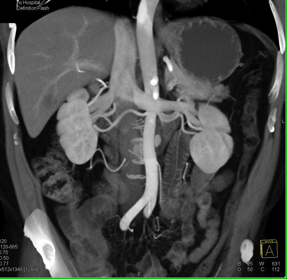 3D Mapping of Normal Vasculature and Minimal Plaque - CTisus CT Scan