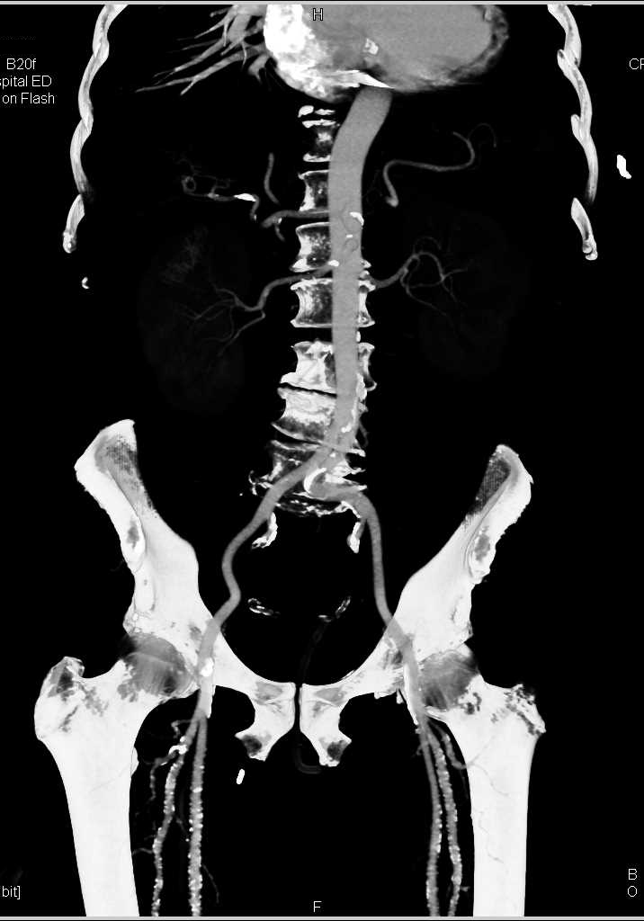 CTA Runoff with Severe Peripheral Vascular Disease - CTisus CT Scan