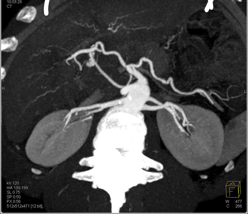 CTA with Gastroduodenal Artery (GDA) Bleed Seen Best on MIP Images - CTisus CT Scan