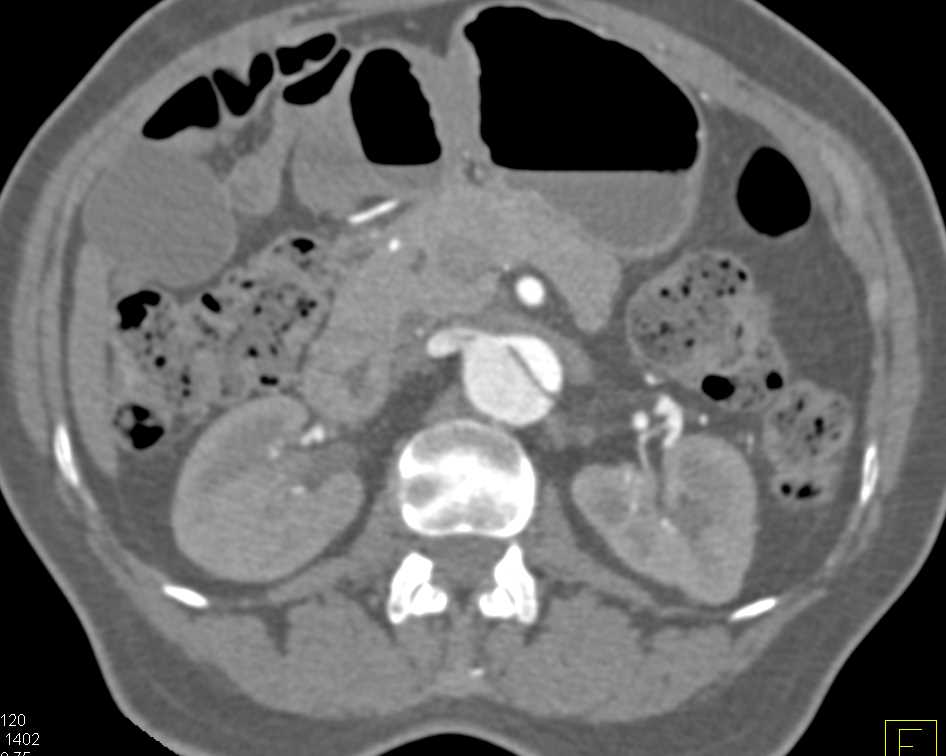 Type B Dissection with Nice Definition of True and False Lumen and Branch Vessels - CTisus CT Scan