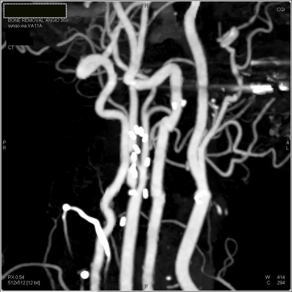Aortobifemoral Graft with Severe Superficial Femoral Artery (SFA) Disease Bilaterally and Critical Stenosis Carotid Artery - CTisus CT Scan
