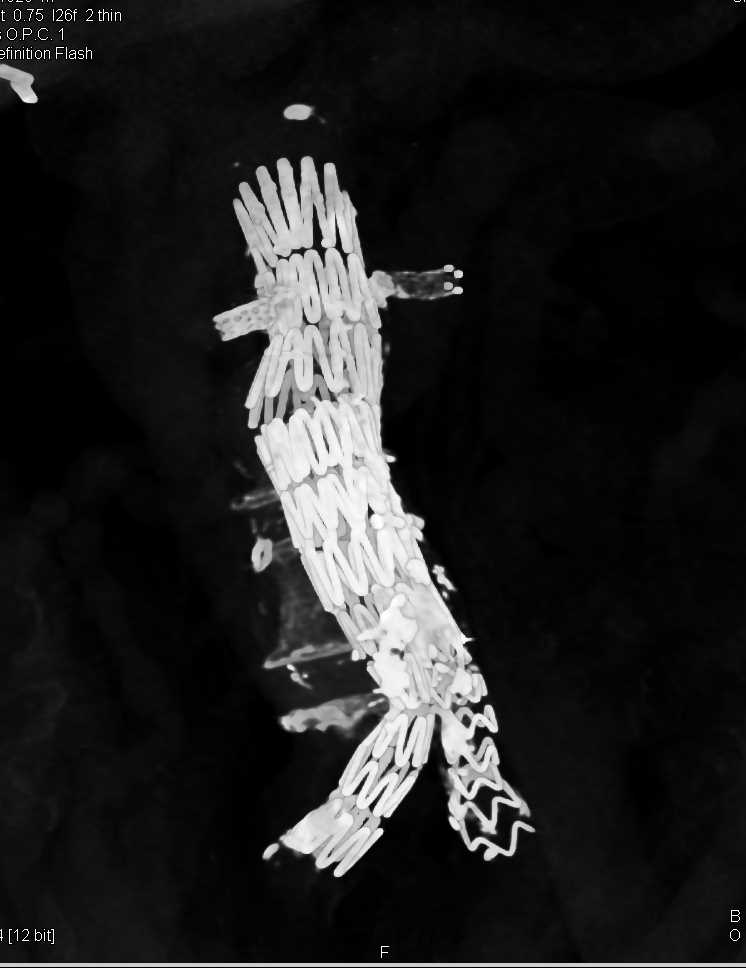 Endovascular Stent with Renal Artery Stents - CTisus CT Scan