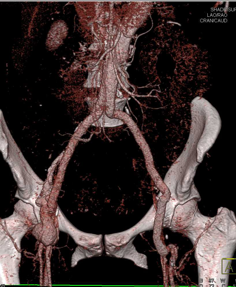 Right Femoral Artery Pseudoaneurysm Following Vascular Graft - CTisus CT Scan