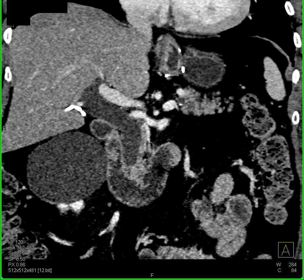 Ampullary Stricture due to Carcinoma - CTisus CT Scan