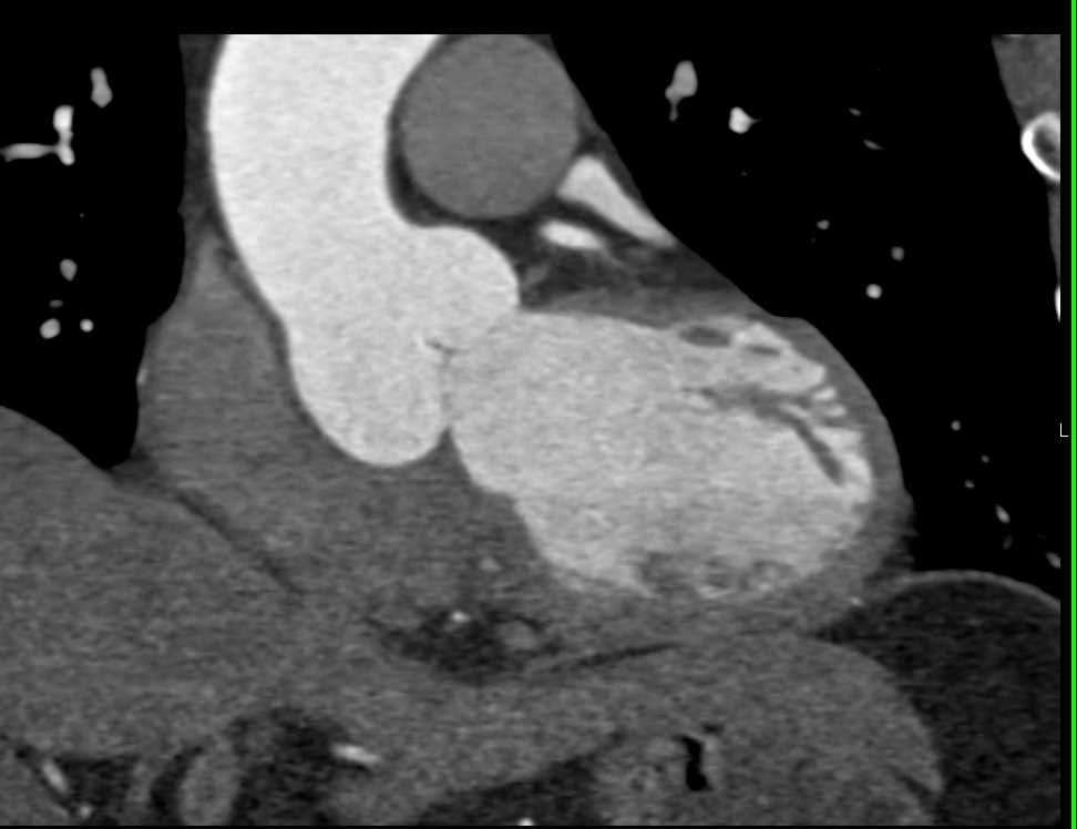 Dilated Aortic Root - CTisus CT Scan