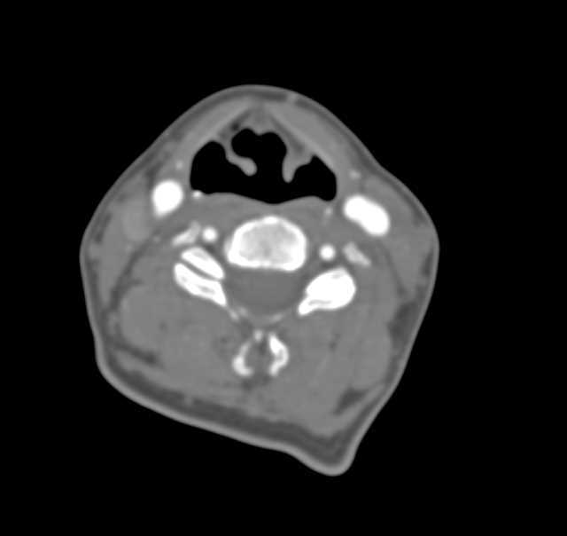 Normal Thoracic Aorta and Incidental Medican Arcuate Ligament Syndrome - CTisus CT Scan