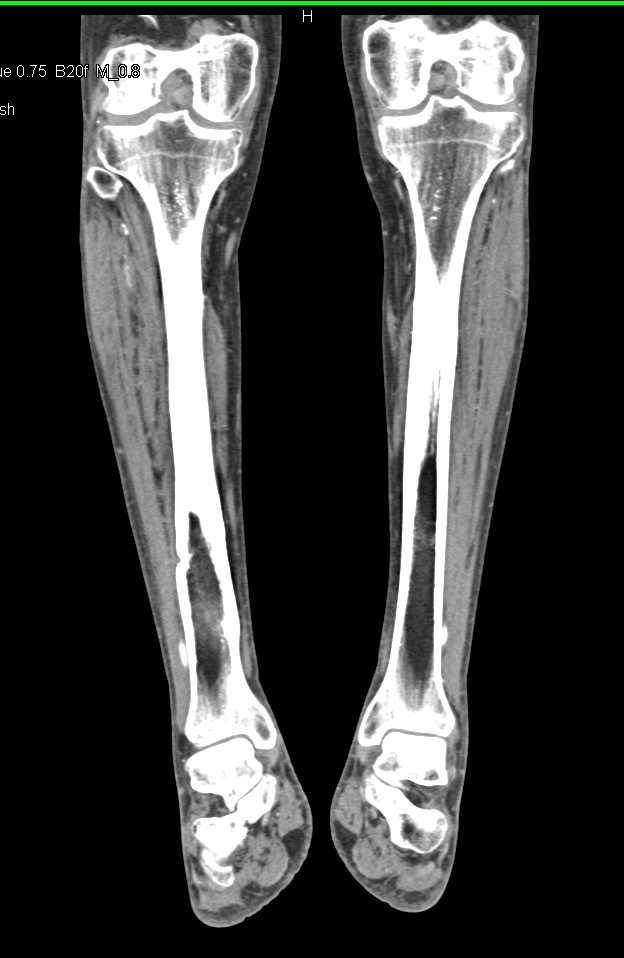 CTA Runoff with Normal Trifurcation Vessels - CTisus CT Scan